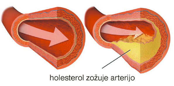 holesterol